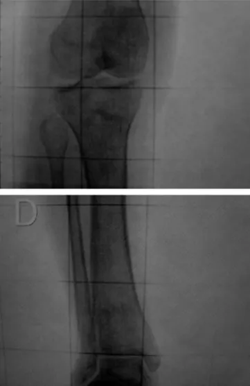 Figure 1 – Radiological examinations on the right knee and ankle, showing a tenuous line of bone continuity in the proximal and distal metaphysis of the right leg.
