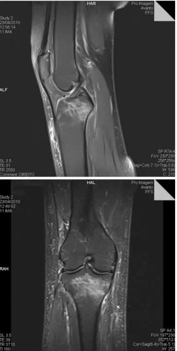 Figure 4 – Area of hypersignal on T2 weighted image, in the proximal region of the right tibia, with solution of