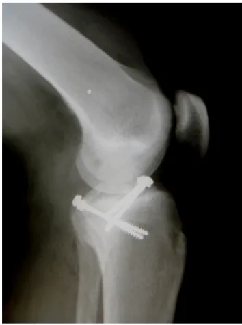 Fig. 6 – Radiograph of the knee six months after the operation, showing anatomical reduction and consolidation.