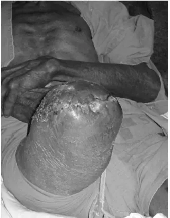 Fig. 1 – Patient amputated due to infection after TKA.