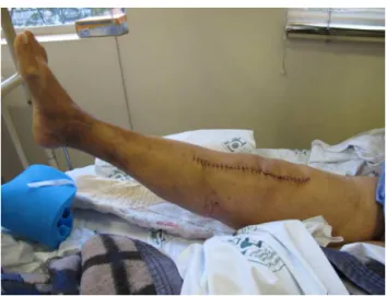 Fig. 3 – Patient with active knee extension in the immediate postoperative period.