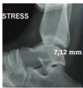 Figure 2 - Stress in radiographic anterior drawer.