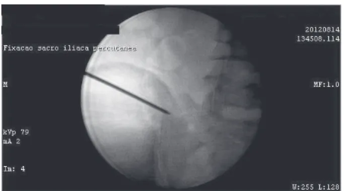 Figure 1 - Percutaneous fixation technique; positioning of  the guidewire with the aid of fluoroscopy in the operating  theater, anteroposterior image.