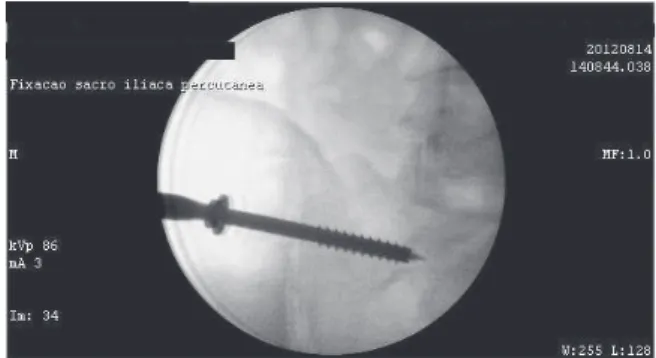 Figure 4 - Percutaneous fixation technique; placement  of cannulated screw with the aid of fluoroscopy in the  operating theater, anteroposterior image.