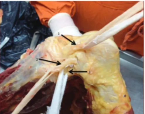 Fig. 2 - Lateral view of the knee showing anterolateral  ligament anteriorly to the lateral collateral ligament.