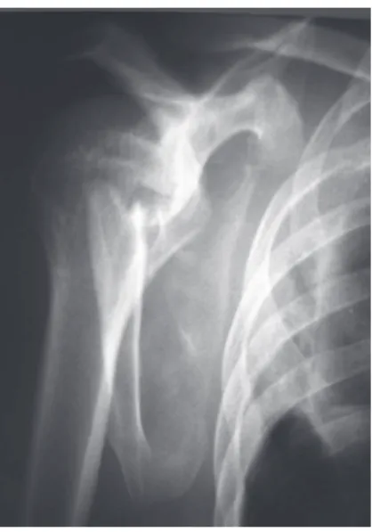 Figure 1 - Scapular lateral radiographic image in which  fracturing of the body of the scapula is shown.