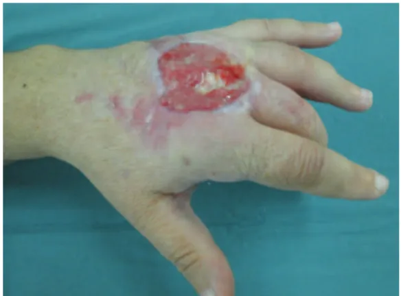 Figure 1 - A 39-year-old female patient with an ulcerative lesion  on the back of one hand, with an initial six months of evolution  after a supposed bite from a spider