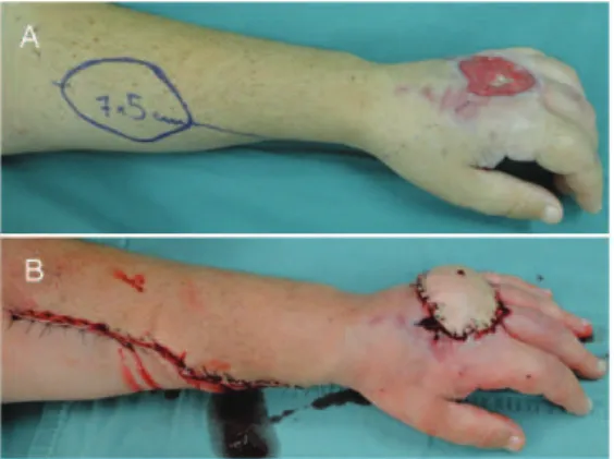 Figure 2 - Preoperative planning to construct a skin flap  from the volar region of the forearm based on reverse flow  of the radial artery (Chinese flap), of dimensions 7 x 5 cm  (A)
