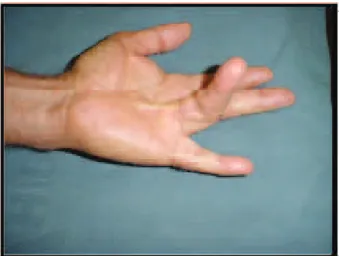 Fig. 3 - Patient number 2, perioperative, with identification  of the longitudinal cord.