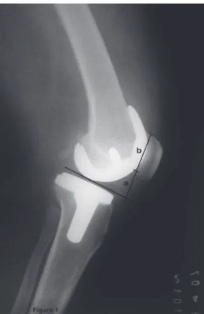 Fig. 1 - Radiography in absolute profile of the knee