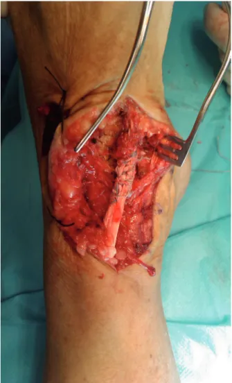 Fig. 2 - Reinserted tendon.