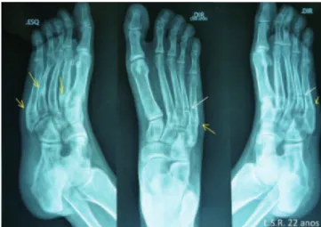 Fig. 1 - Oblique view x-rays of the left foot; AP and oblique  view of the right foot showing fractures in different stages of  consolidation, with no history of major trauma or previous  complaint of pain.