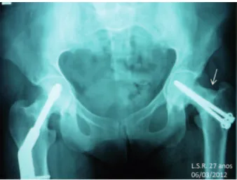 Fig. 2 - AP view x-ray of coxofemoral joint; the arrows show  signs of stress fractures of the femoral neck.