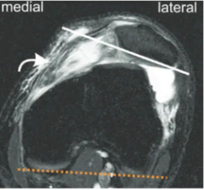Fig. 3 - T2-weighted MRI with fat suppression in the axial  plane, showing dysplastic trochlea characterized by a  convex lateral facet (arrows).