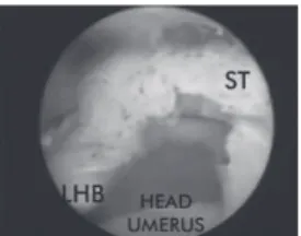 Fig. 1 - Lateral view of the left shoulder: extensive lesion of  the supraspinatus with deficient rotator interval