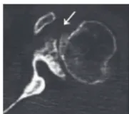 Fig. 1 - Image of a glenoid cavity (arrow) with insufficient  bone stock, in which it would be possible to insert an  implant.