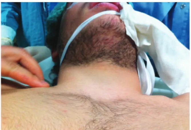 Fig. 3 - Depression of the medial edge of the right clavicle.