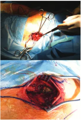 Fig. 7 - Ligament repair using mini-anchor and  transosseous stitches.