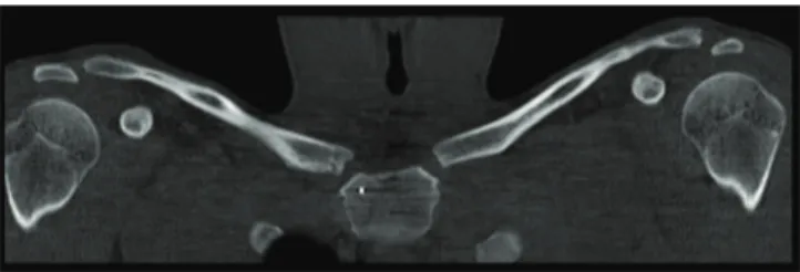 Fig. 8 - Control CT produced seven months after the  operation (coronal view).