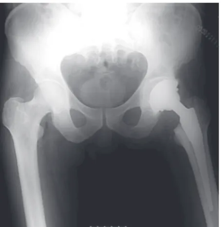 Fig. 1 - Immediate postoperative X-ray on left-side total hip  arthroplasty.