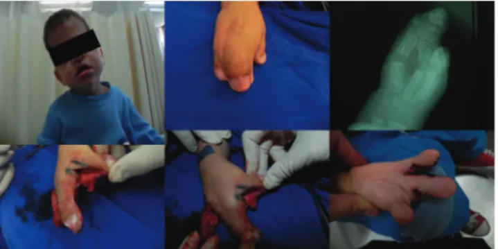 Fig. 16 - Use of external fixators for treating syndactyly. 28    Fig. 18 - Zetaplasty of pterygium.