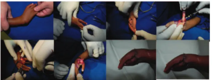 Fig. 23 - Camptodactyly. Transfer of flexor digitorum su- su-perficialis to extensor and lateral flap: before operation (A); 