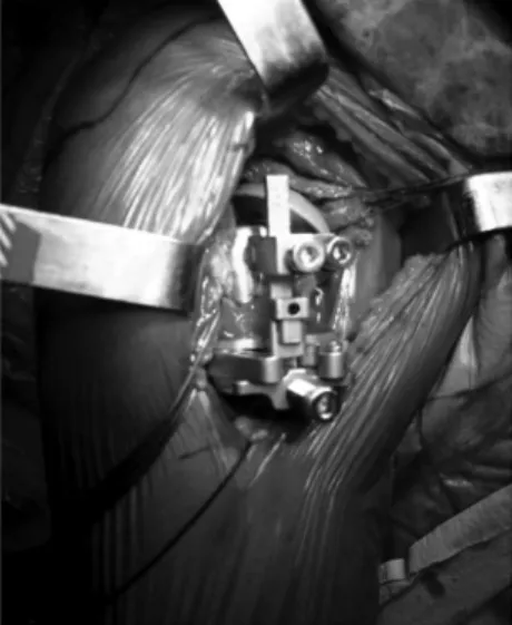Fig. 2 - Positioning of the test prosthesis using the  positioning jig.