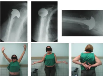 Fig. 8 - Example of patient with good radiological and  clinical results.