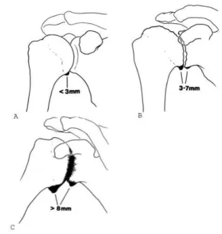 Fig. 1 - Samilson and Prieto classification:12 A) Mild  arthrosis – lower osteophyte of the humeral head and/or  glenoid smaller than 3 mm; B) Moderate arthrosis – lower  osteophyte of the humeral head and/or glenoid measuring  3 to 7 mm, with gentle irreg
