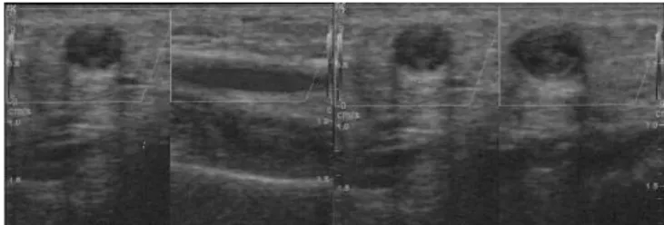 Fig. 1 - Doppler ultrasound on the ulnar artery. It was found  to be dilated, with thickened walls, although with flow  present, in the middle third of the forearm (A), while in  the distal third (B) there was echogenic material inside the  vessel (thrombu