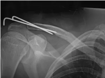 Fig. 2 - Reduction of the acromioclavicular dislocation and Fig. 1A - Incomplete diaphyseal fracture of the right clavicle 