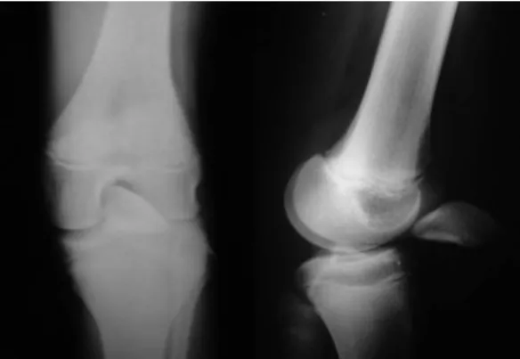 Fig. 3 - Postoperative radiograph of the left knee.