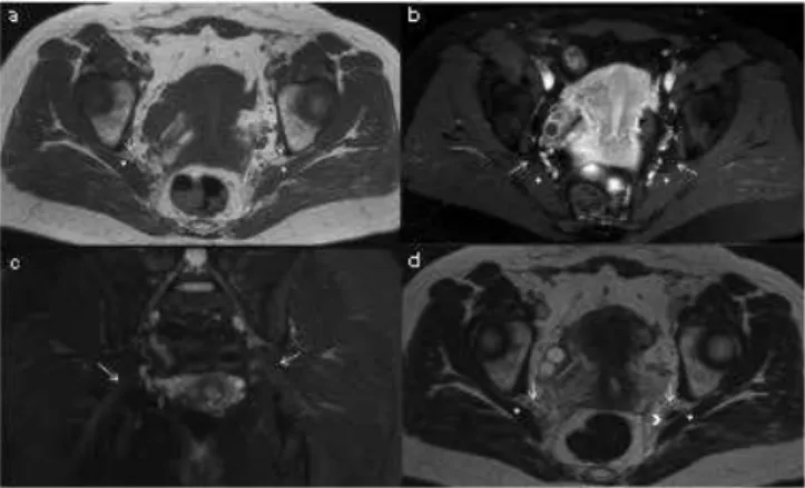 Fig. 1 - Magnetic resonance diagnosed as normal. T1 in  axial plane (a) and FSE T2 with fat saturation in the axial  plane (b) and coronal plane (c) of thickness 5 mm