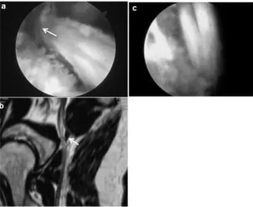 Fig. 2 - Magnetic resonance neurography: reformatting to  the major axis of the sciatic nerve (arrow) on the right side  (a) which passes anteriorly to the piriformis muscle