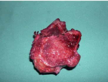 Fig. 12 – Intraoperative photograph of excision of an osteochondroma. Note its multilobulated surface and cartilage cover.