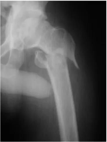 Fig. 2 – Radiograph showing Tronzo type V transtrochanteric fracture.