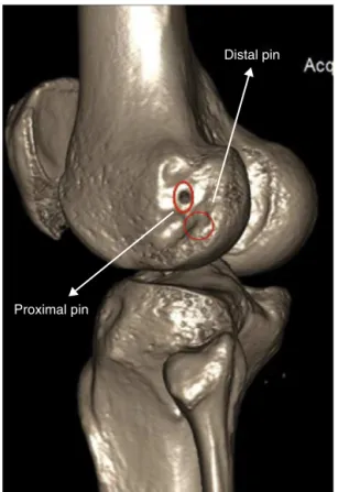 Table 1 – Position of the Rigidfix pins in the lateral condyle in relation to the joint cartilage.
