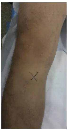 Fig. 2 – Location above the surgical scar.