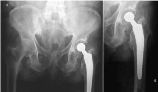Fig. 3 – Cemented total hip arthroplasty performed five years before the present case.