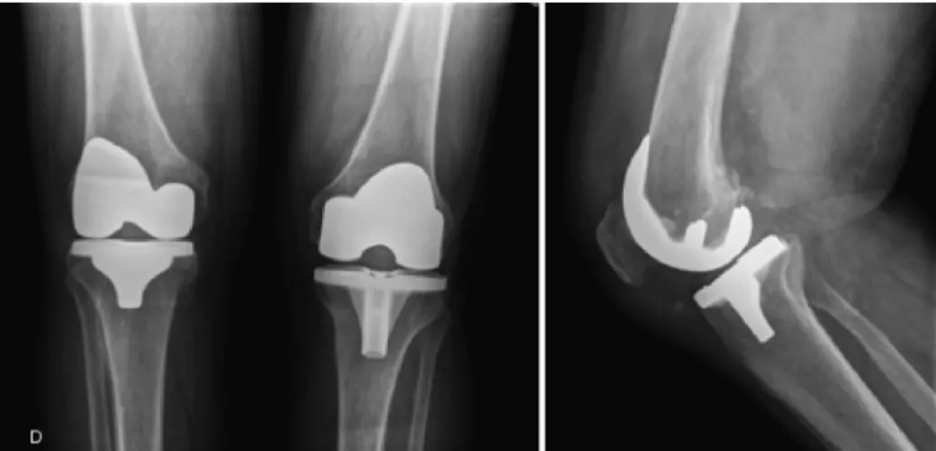 Fig. 5 – Radiograph of the knees with weight-bearing and lateral view of the right knee six months after total arthroplasty.
