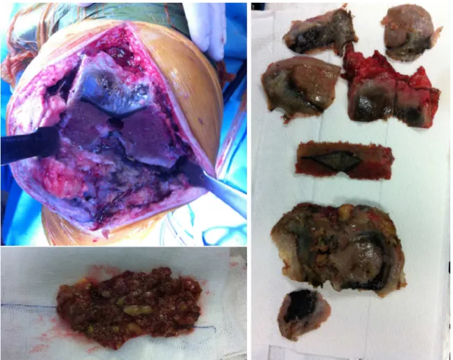 Fig. 6 – Intraoperative images documenting the typical dark coloration of the joint that resulted from deposition of pigments from homogentisic acid in the joint cartilage, menisci, tendons and ligaments.