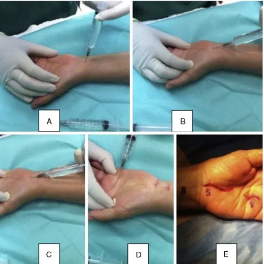 Fig. 1 – Infiltration of anesthesia in a patient who underwent surgical treatment for carpal tunnel syndrome and trigger finger