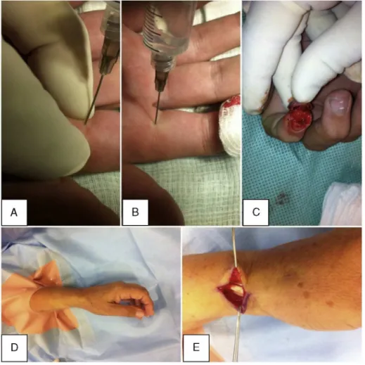 Fig. 2 – (A) and (B) Anesthesia at the base of the finger, at its midline and at the digital palmar crease, with traction by the surgeon’s fingers to facilitate entry and diffusion of the anesthetic