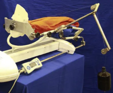 Fig. 3 – L-shaped optical markers on the femur and tibia.