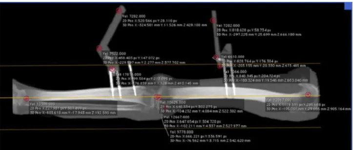 Fig. 5 – Mechanical axis of the lower limb: three-dimensional points at the center of the femoral head and ankle.