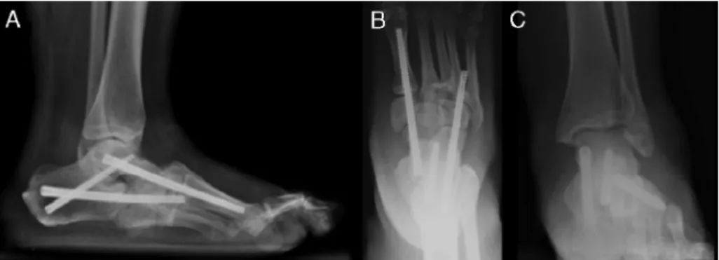 Fig. 5 – Radiographic control 12 months after the operation: (A) lateral view of the foot showing evidence of correction of the alignment of the axis of the talus with the first metatarsal; (B) anteroposterior view of the foot showing maintenance of the al