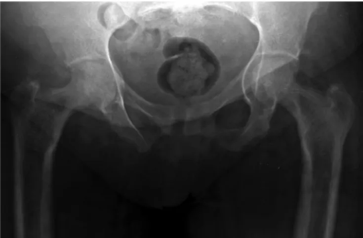 Fig. 1 – Initial anteroposterior radiograph on the pelvis. No fracture was identified.