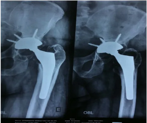Fig. 1 – Radiographs of the left hip in anteroposterior and oblique views (December 27, 2010) showing total arthroplasty performed 17 years earlier.