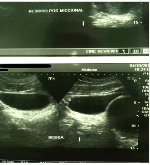 Fig. 2 – Echographic images of the urinary tract and prostate showing mass of cystic appearance close to the bladder.