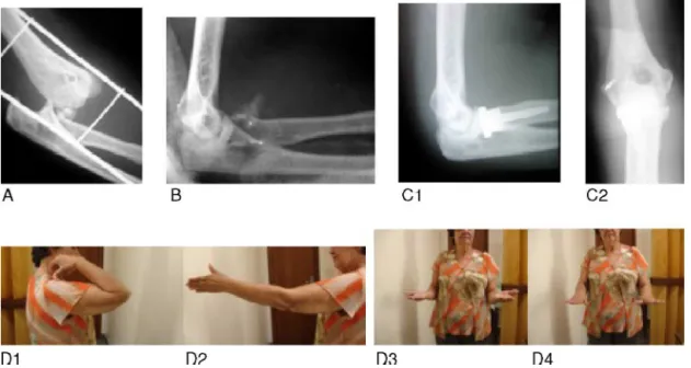 Fig. 2 – A 54-year-old woman who suffered a fall from a standing position. (A) Lateral radiograph prior to reduction, showing posterior dislocation of the elbow and fracturing of the radial head
